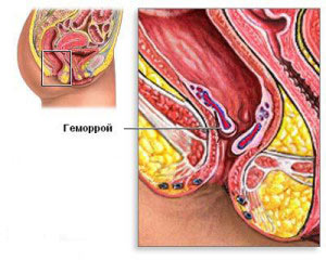 Диета при геморрое